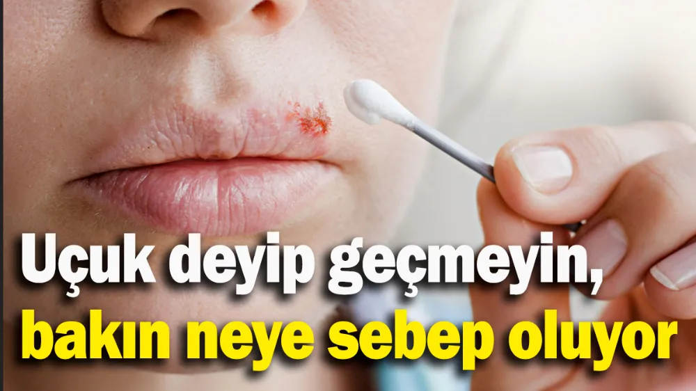 Uçuk deyip geçmeyin, bakın neye sebep oluyor
