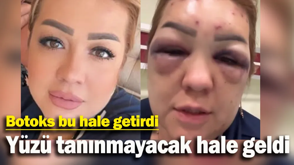 Botoks bu hale getirdi