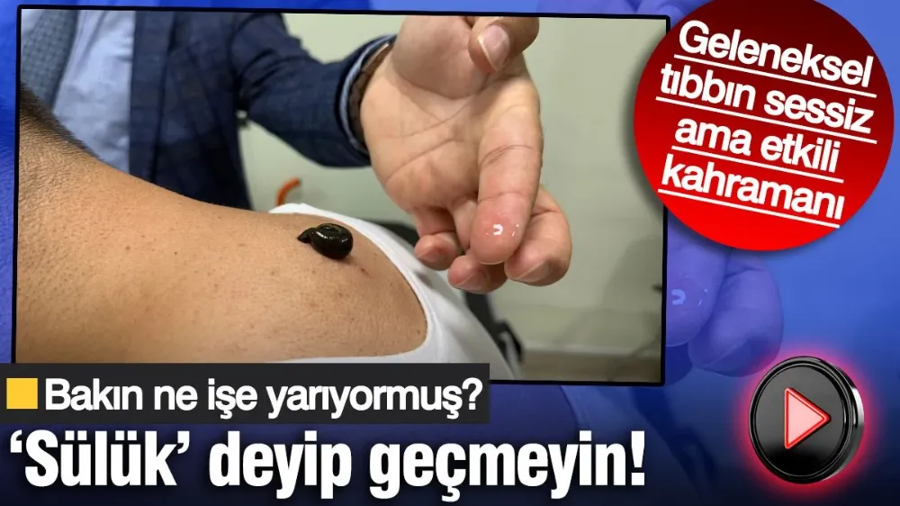 ‘Sülük’ deyip geçmeyin! Bakın ne işe yarıyormuş? 